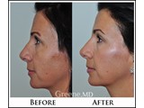 Liquid Cheek Lift Before and After Photo
