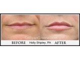 Lip Augmentation by Holly

