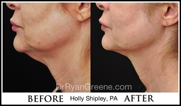 Kybella Gallery By Holly