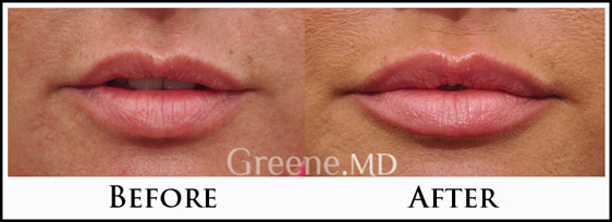 Lips by Greene