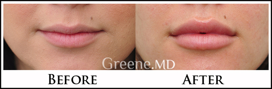 Lip Augmentation by Dr. Greene