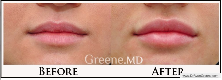 Lip Injections by Dr. Ryan Greene