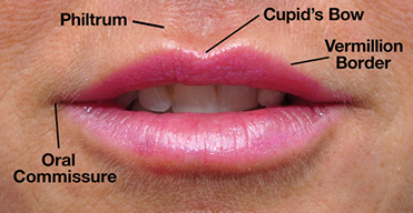 Lip Augmentation diagram Dr. Ryan Greene Weston, Florida