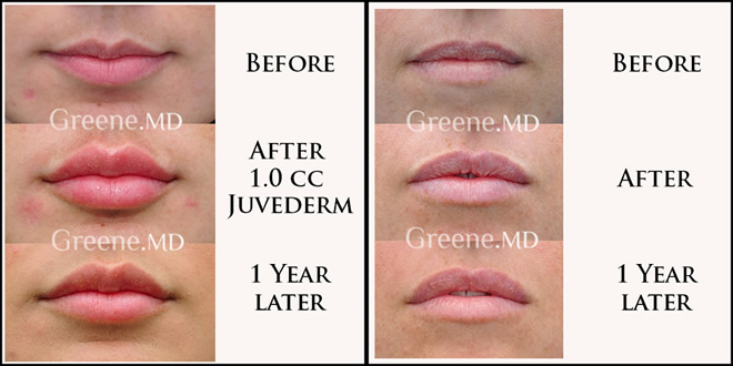 Lip Augmentation 1 Year Later Results Dr. Ryan Greene