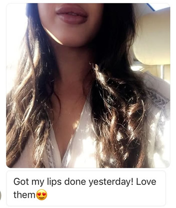 Best Lip Augmentation by Dr. Ryan Greene