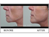 IPL Laser Photo Facial Before and After Photo