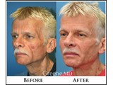 Sculptra Before and After Photo