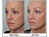 Liquid Cheek Lift Before and After Photo