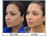 Juvederm VOLUMA XC Before and After Photo