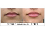 Lip Augmentation by Holly