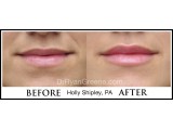 Lip Augmentation by Holly