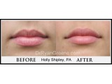 
Lip Augmentation by Holly