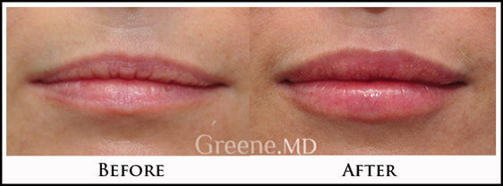 Restylane for Lips