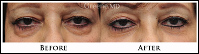 Restylane Under Eye Treatment
