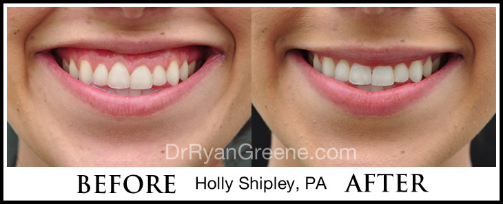 Before and After Botox for Gummy Smile