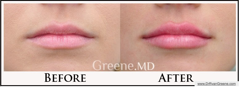 Lip Augmentation Expert Dr. Ryan Greene