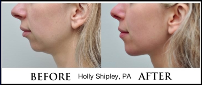 Chin Filler Gallery By Holly