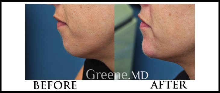 Chin Fat Removal Kybella before and after