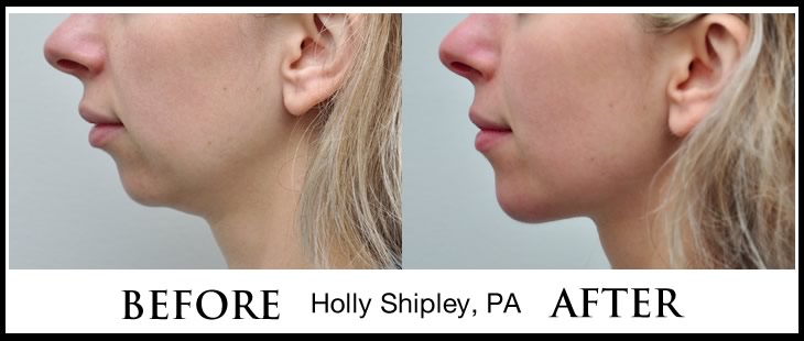 Chin Fat Removal Kybella before and after 