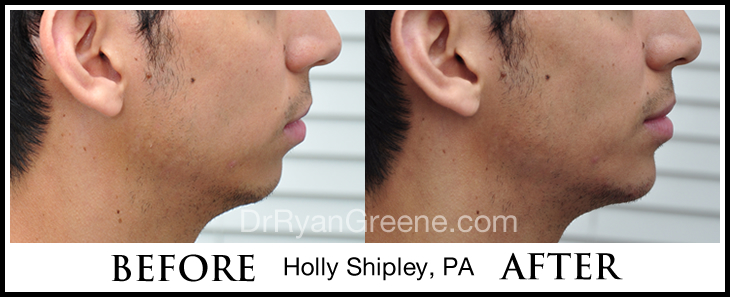 Chin Fat Removal Kybella before and after