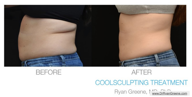 Coolsculpting Before After Weston