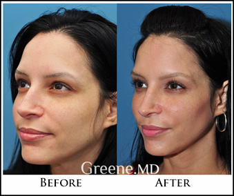 Liquid Facelift with Fillers