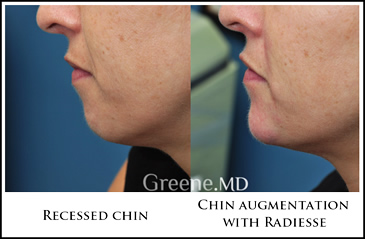 Chin Augmenation with Fillers