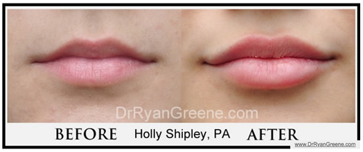 Lip Enhancement by Holly Shipley, PA