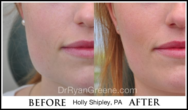 Jawline Slimming with BOTOX