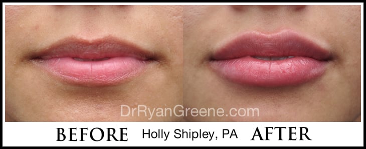 Holly's Lip Augmentation Gallery