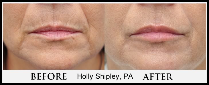 Lower Face Filler Gallery By Holly