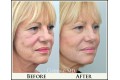 Juvederm Before and After Photo