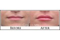 Juvederm Before and After Photo
