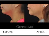 Kybella Before and After Photo