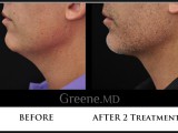 Kybella Before and After Photo