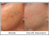 IPL Laser Photo Facial Before and After Photo
