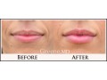 Lip Fillers Before and After Photo
