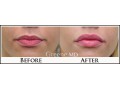 Lip Fillers Before and After Photo