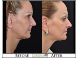 Ultherapy Before and After Photo