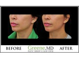 Ultherapy Before and After Photo