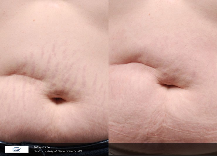 Non-Ablative Resurfacing Case 10 Combined Image