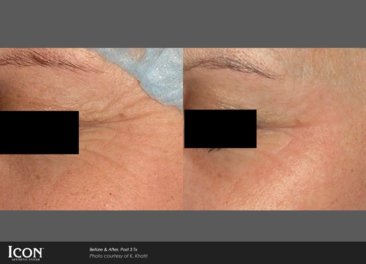 Non-Ablative Resurfacing Case 11 Combined Image