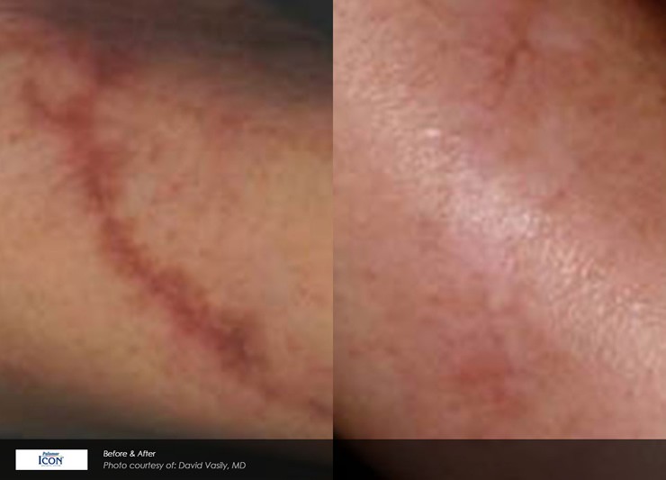 Non-Ablative Resurfacing Case 12 Combined Image