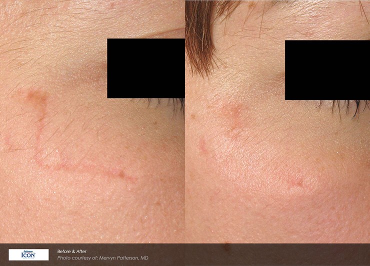 Non-Ablative Resurfacing Case 13 Combined Image