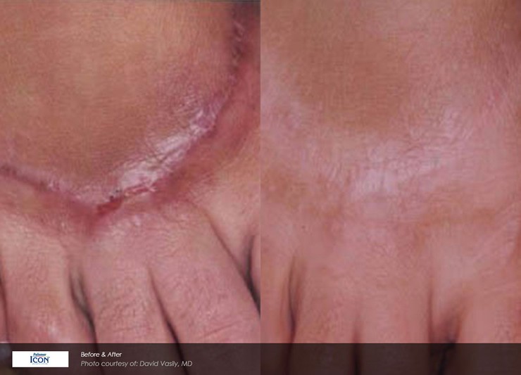 Non-Ablative Resurfacing Case 14 Combined Image
