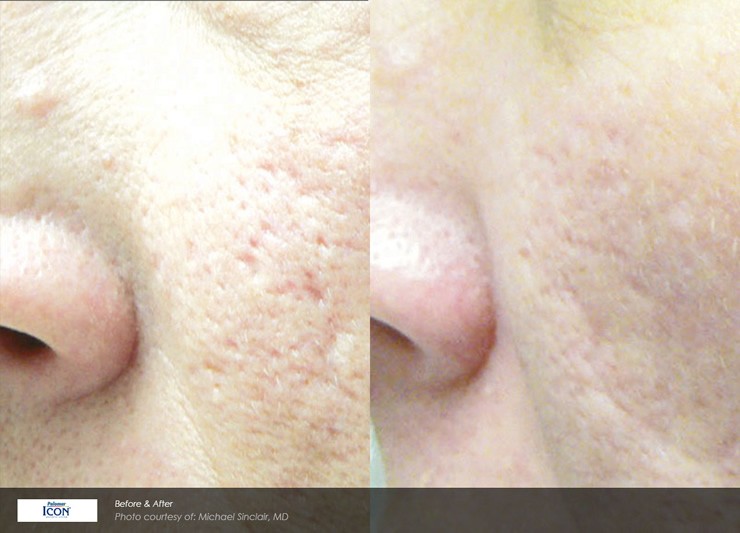 Non-Ablative Resurfacing Case 5 Combined Image