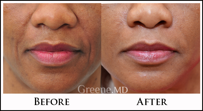 Lower Face Filler Case 8 Combined Image