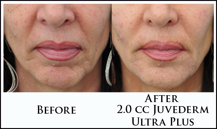 Lower Face Filler Case 9 Combined Image