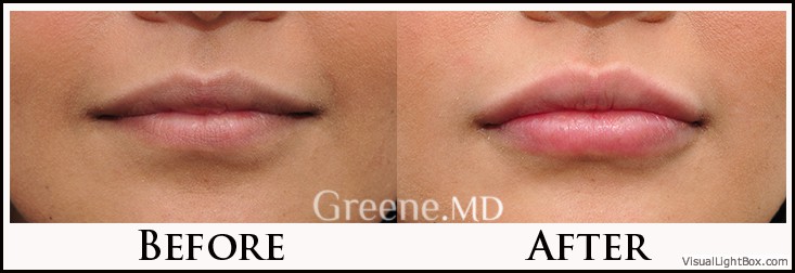 Lip Filler Case 63 Combined Image