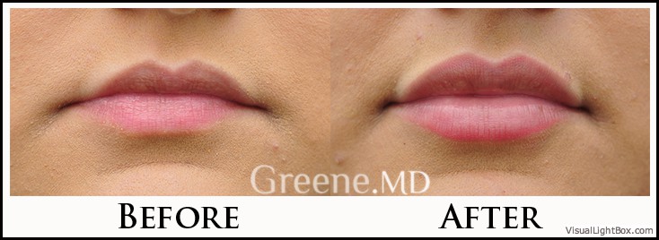 Lip Filler Case 71 Combined Image